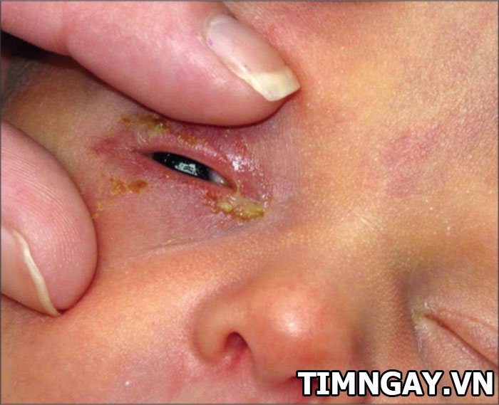 Nguyên nhân trẻ bị đau mắt có ghèn và cách chữa hiệu quả tại nhà 1