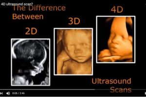 Siêu âm 4D xác định giới tính thai nhi có chính xác không?