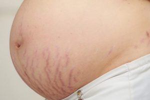Cách ngăn ngừa vết rạn da khi mang thai bằng dầu dừa cho mẹ bầu